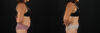 Tummy Tuck case #7614 slider thumbnail