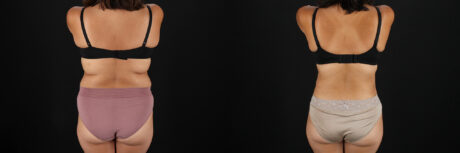 Tummy Tuck case #7614