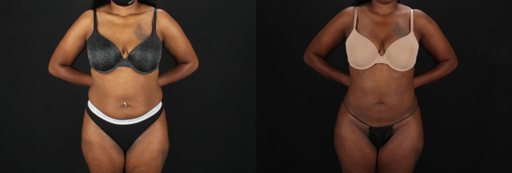 Brazilian Butt Lift case #5455