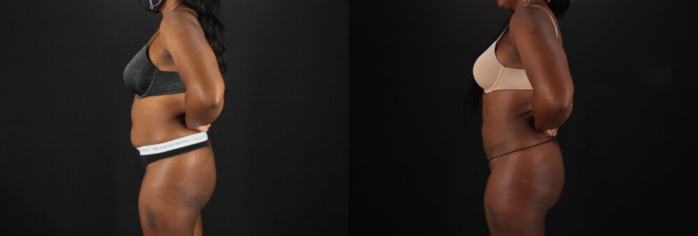 Brazilian Butt Lift case #5455