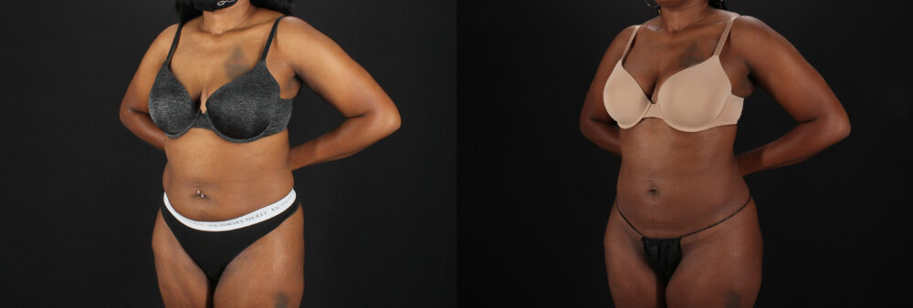 Brazilian Butt Lift case #5455