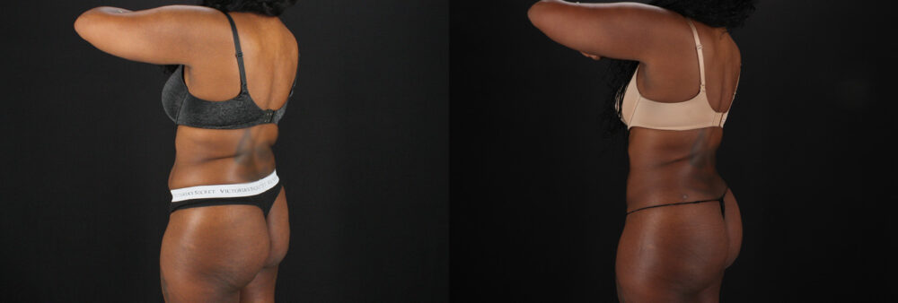 Brazilian Butt Lift case #5455