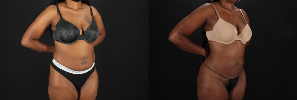 Brazilian Butt Lift case #5455