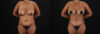 Tummy Tuck case #7619 slider thumbnail