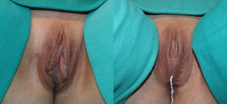 Labiaplasty case #5793