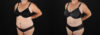 Tummy Tuck case #7624 slider thumbnail