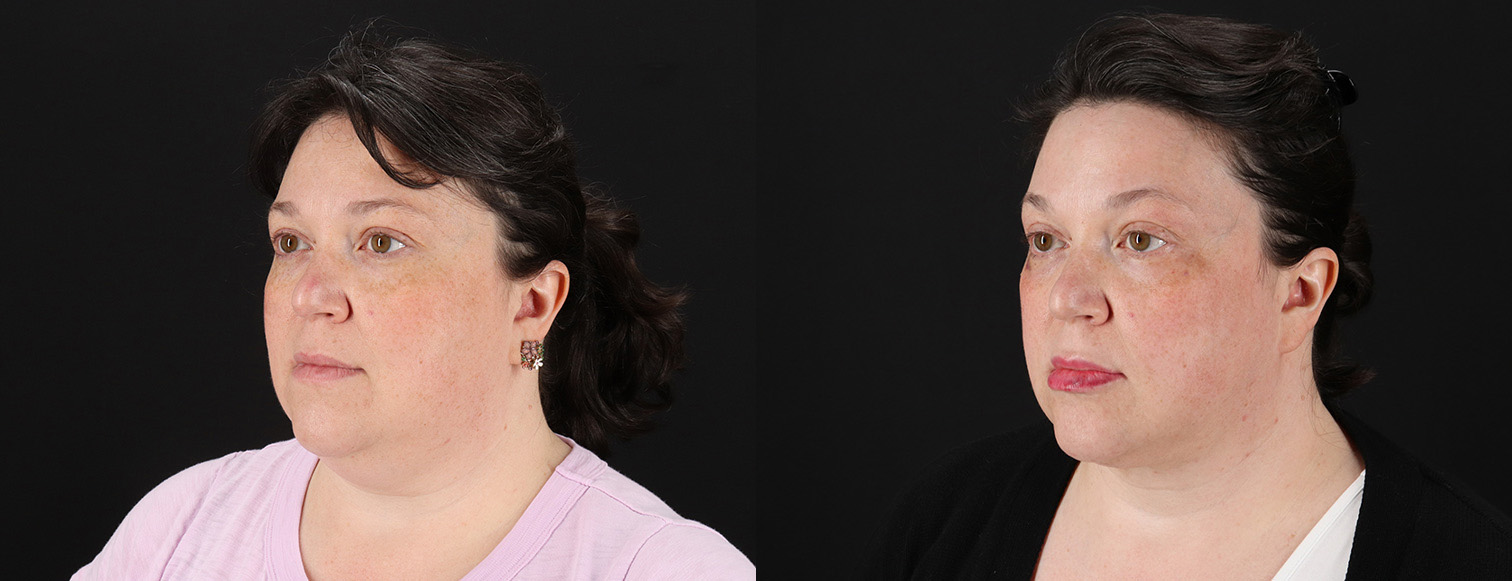 18255-19283-Profound-RF-Skin-Tightening-before-and-after-photo-by-Dr.-Erika-A.-Sato-in-Houston-TX