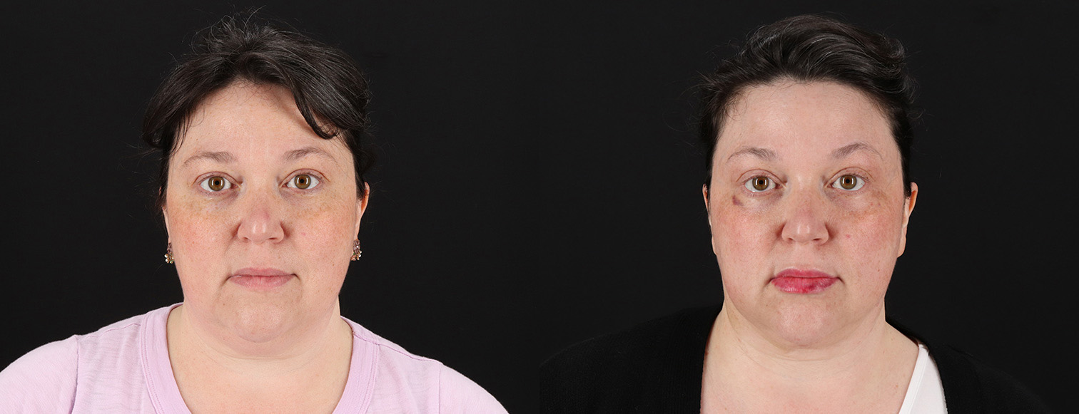 18255-33041-Profound-RF-Skin-Tightening-before-and-after-photo-by-Dr.-Erika-A.-Sato-in-Houston-TX
