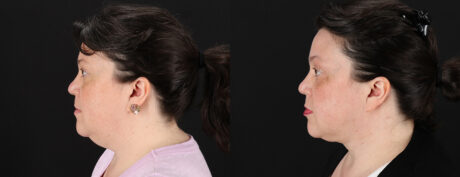 Submental Liposuction case #6955
