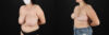 Breast Reduction case #8006 slider thumbnail