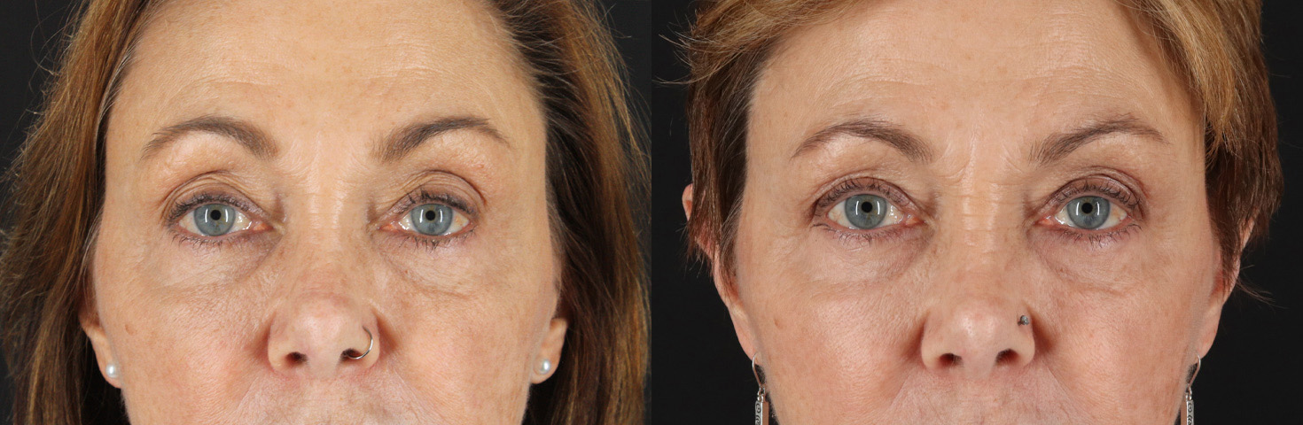 18649-48033-Blepharoplasty-before-and-after-photo-by-Dr.-Erika-A.-Sato-in-Houston-TX