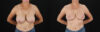 Breast Reduction case #8012 slider thumbnail