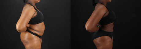 Liposuction case #6122