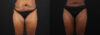 Liposuction case #6122 slider thumbnail