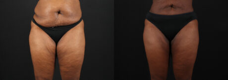 Liposuction case #6122