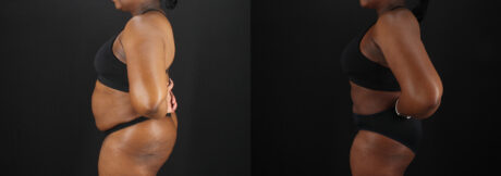 Liposuction case #6122