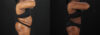 Liposuction case #6122 slider thumbnail