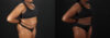 Liposuction case #6122 slider thumbnail