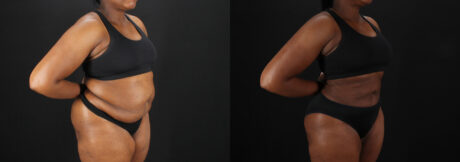 Liposuction case #6122