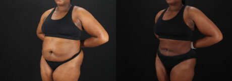 Liposuction case #6122