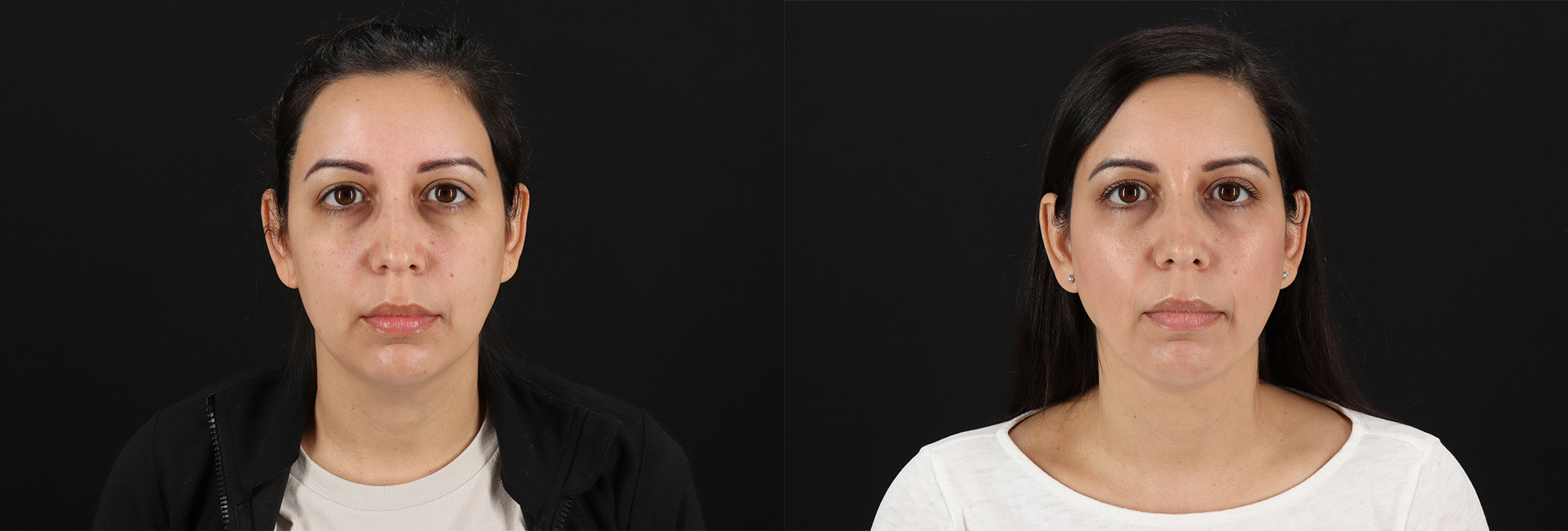 19093-16794-Submental-Liposuction-before-and-after-photo-by-Dr.-Erika-A.-Sato-in-Houston-TX