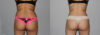 Liposuction case #5836 slider thumbnail