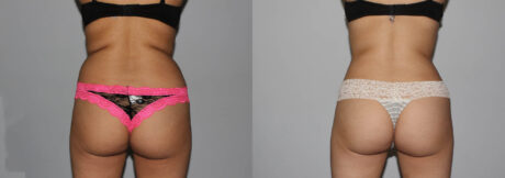 Liposuction case #5836