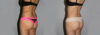 Liposuction case #5836 slider thumbnail