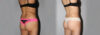Liposuction case #5836 slider thumbnail