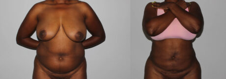 Liposuction case #5829