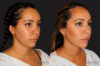 Submental Liposuction case #6943 slider thumbnail