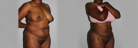 Liposuction case #5829