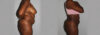Liposuction case #5829 slider thumbnail