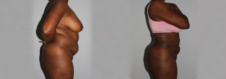 Liposuction case #5829