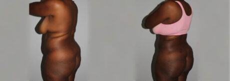 Liposuction case #5829