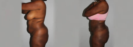 Liposuction case #5829