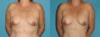 Fat Grafting to the Breast case #8044 slider thumbnail