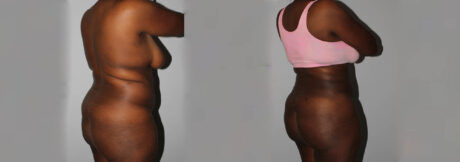 Liposuction case #5829