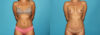 Liposuction case #5889 slider thumbnail