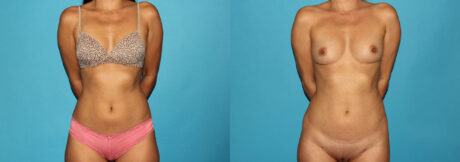 Liposuction case #5889