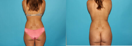 Liposuction case #5889