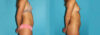 Liposuction case #5889 slider thumbnail