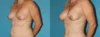 Fat Grafting to the Breast case #8044 slider thumbnail