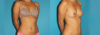 Liposuction case #5889 slider thumbnail