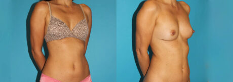 Liposuction case #5889