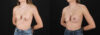 Revision Breast Surgery case #256261 slider thumbnail