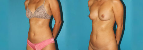 Liposuction case #5889