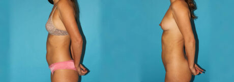 Liposuction case #5889