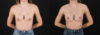 Revision Breast Surgery case #256261 slider thumbnail