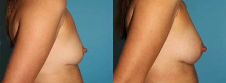 Fat Grafting to the Breast case #256155